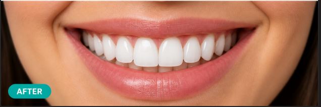 Full Mouth Rehabilitation